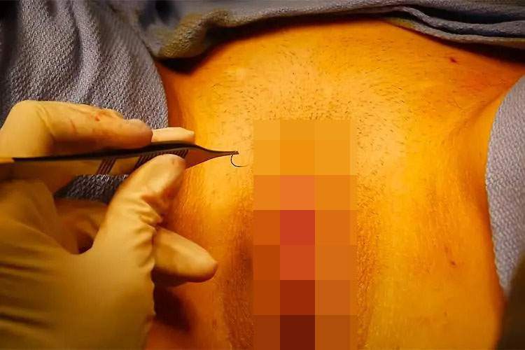 【小陰唇縮小手術】マンコのビラビラを切って小さく整える整形手術の一部始終！