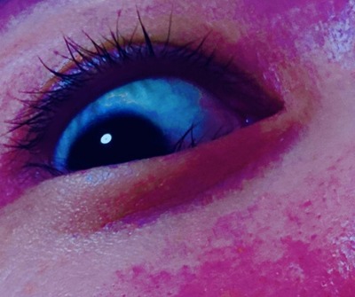 【画像】 眼科医『目が充血してる人、”こう”なってたらすぐに病院来い』