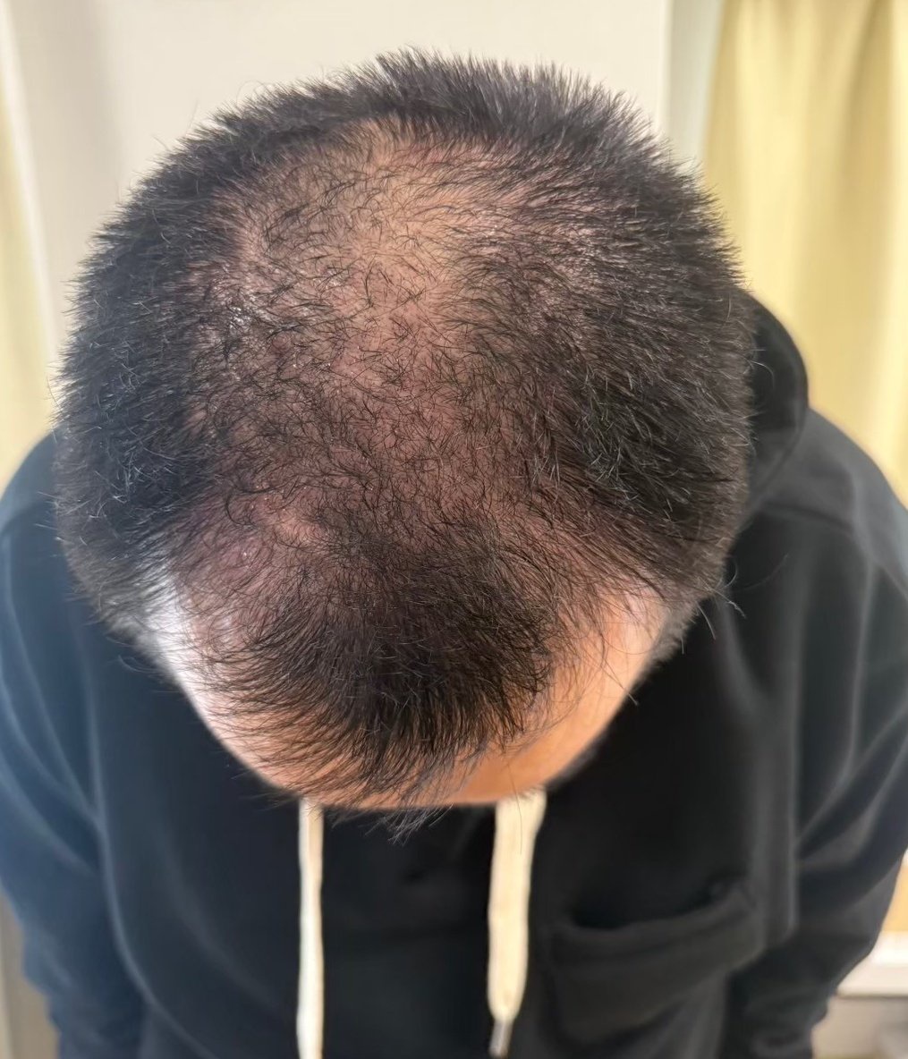 【衝撃】 ミルクボーイ内海『”8000円の発毛剤”を3ヶ月使った結果がこれ』→