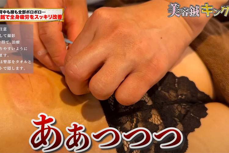 美容鍼&吸い玉の施術を受ける黒Ｔバック姿の女性モデル