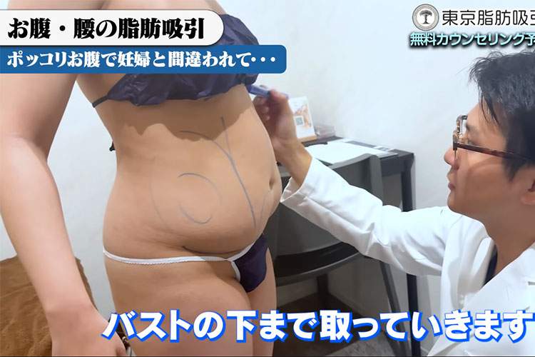 電車で妊婦と間違えられたポッコリお腹の女性が脂肪吸引の施術を受ける様子